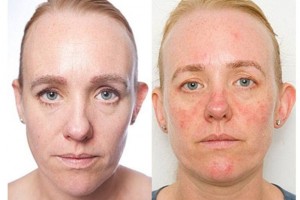 ESTRAGOS. La textura de su piel empeor en alrededor de un 10%, lo que -segn le seal una dermatloga- proba